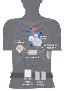 Schematic depiction of the artificial heart system (Source: www.reinheart.de/systemueberblick)